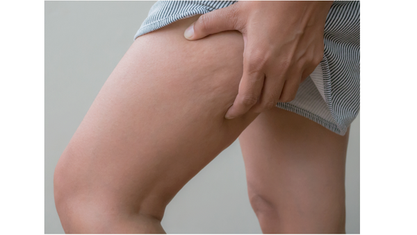 What causes cellulite?