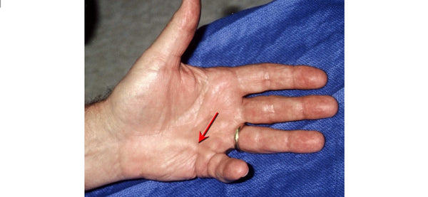 Dupuytren's Contracture and MELT