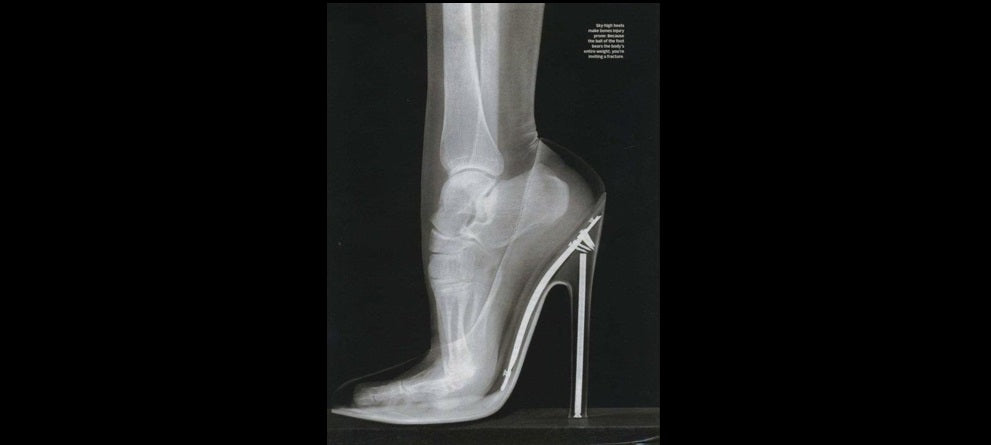 High Heels and Bunions | MELT Blog - MELT Method